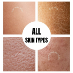 Natural acne oil suitable for oily, dry, combination and normal skin types for balanced skincare