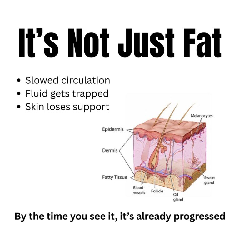 diagram showing skin layers with cellulite formation caused by poor circulation fluid retention and weakened connective tissue