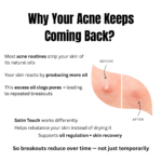 Explanation of recurring acne caused by excess oil production and clogged pores with Satin Touch solution