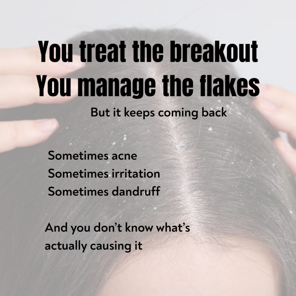Person dealing with dandruff and scalp flakes showing recurring acne and scalp issues problem