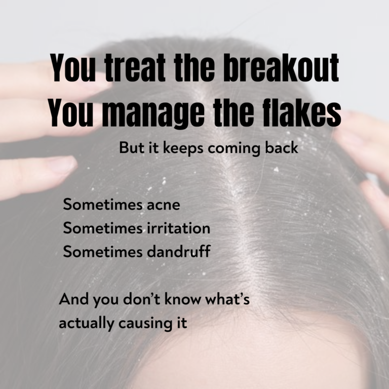 Person dealing with dandruff and scalp flakes showing recurring acne and scalp issues problem