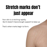 Close-up of skin with stretch marks showing how rapid skin stretching without support leads to marks